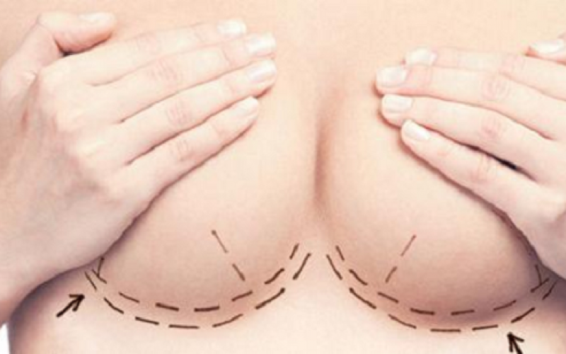 Implantes mamarios: ¿Una tendencia en alza en temporada estival?
