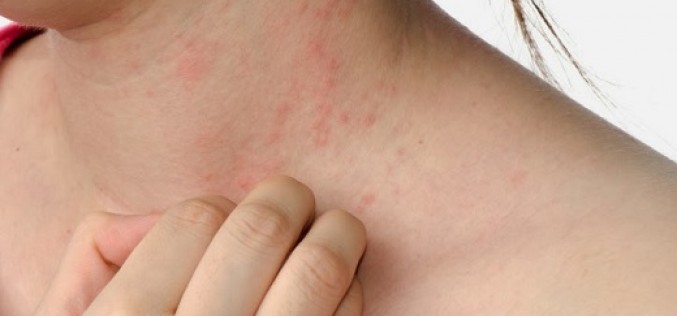 Psoriasis: Cuando nuestra piel se convierte en enemigo