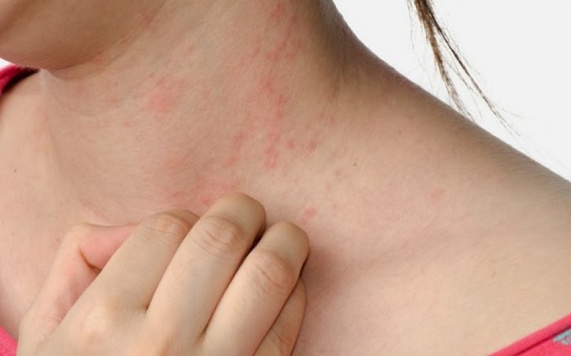 Psoriasis: Cuando nuestra piel se convierte en enemigo