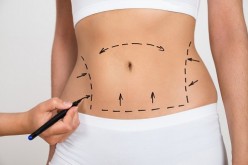 Liposucción: todo lo que hay que saber sobre este procedimiento