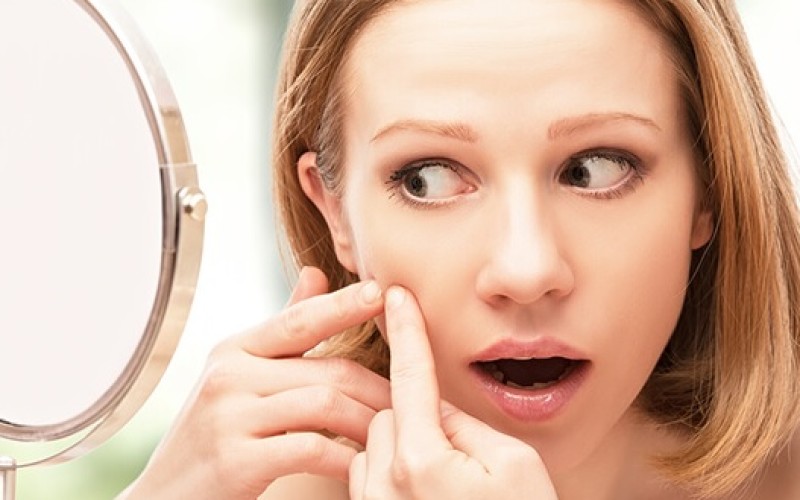 Secuelas de acné: Cuando ciertas etapas de la vida dejan sus marcas en la piel