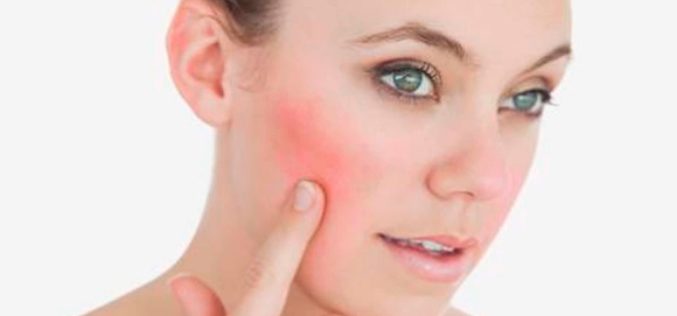 Un 80% han aumentado consultas por dermatitis, rosácea, descamación, acné y manchas en la piel