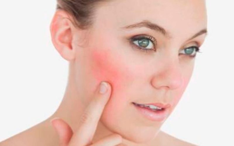 Un 80% han aumentado consultas por dermatitis, rosácea, descamación, acné y manchas en la piel