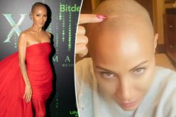 Alopecia: ¿cuáles son sus principales causales y tratamientos?