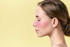 Rosácea en la cara: aprende a tratarla