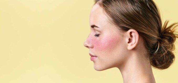 Rosácea en la cara: aprende a tratarla